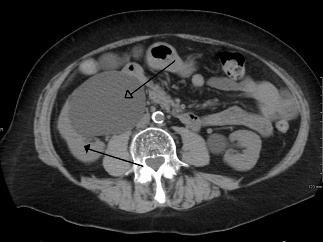 Hydronephrosis marked by the top arrow (Wikicommons)
