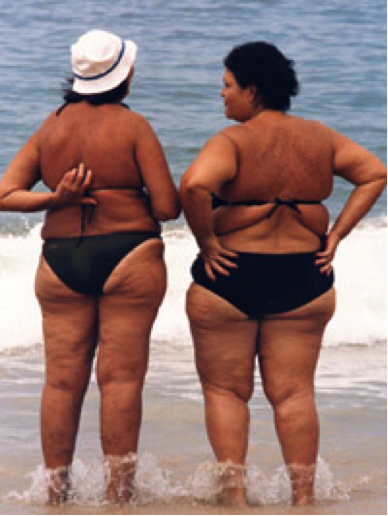 cellulite