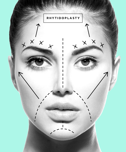 plastic-surgery-05-Rhytidoplasty