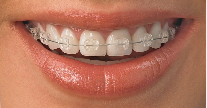ceramicbraces
