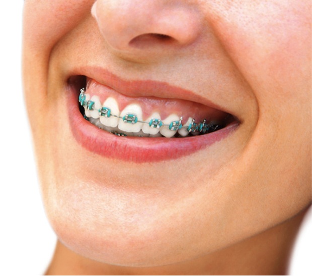 metalbraces