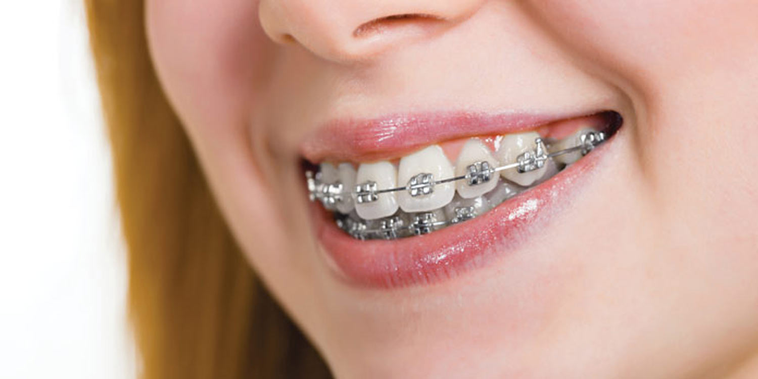 bracesmetal