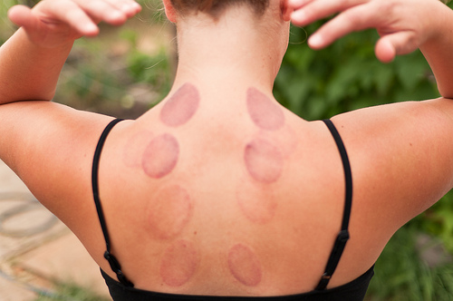 cupping