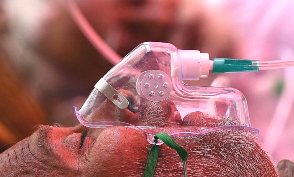 Black Fungus: An Aftermath of COVID-19 with a 50% Mortality Rate