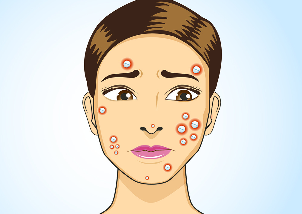 Say Bye Bye To Acne With This Skincare Routine