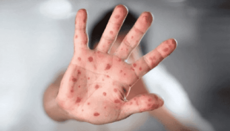 The Unusual Spread of Monkeypox and How the UAE Is Taking Precautionary Measures